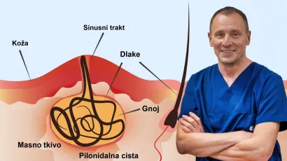 Dr. Mario Bartol ovaj čest problem u Poliklinici Maletič rješava laserom (ilustracija)