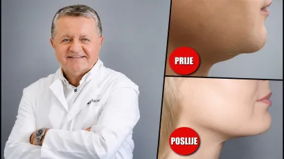 Dr. Du&scaron;ko Maletić svojom "formulom" za podbradak postiže sjajne rezultate/ Foto: Poliklinika Maletić