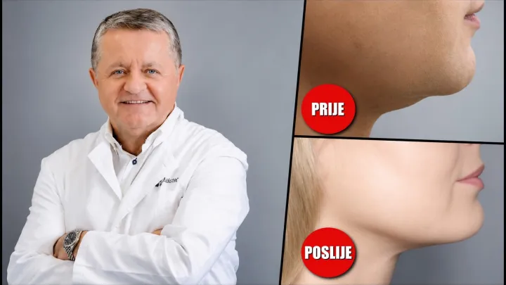 Dr. Du&scaron;ko Maletić svojom "formulom" za podbradak postiže sjajne rezultate/ Foto: Poliklinika Maletić
